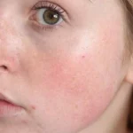 bliver-dit-ansigt-pludselig-roedt-der-er-6-grunde.webp.webp